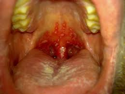 Image result for Physical injury red spots roof of mouth