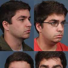 The Genius Revitalize Permanently MicroNeedling