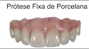 Protese Fixa De Porcelana Sem Implantes Youtube