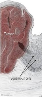 The only way you will be able to get the answers you need would be by asking your mum's oncologist the questions you have, including why chemo is now only being considered as palliative care. Squamous Cell Carcinoma Harvard Health
