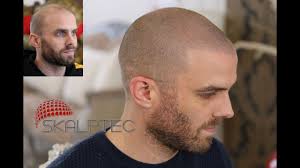 For hair loss sufferers, a scalp tattoo is fast becoming one of their preferred options to camouflage their baldness. Hair Tattoo Best Hair Tattoo Solution For Hair Loss Skalptec Ltd