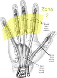 A deep cut on the palm side of your fingers, hand, wrist, or forearm can damage your flexor tendons, which are the tissues because flexor tendons are very close to the surface of the skin, a deep cut will most likely hit a flexor tendon. Flexor Tendon Injuries Hand Orthobullets