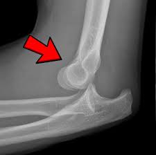 Image result for Elbow Dislocation