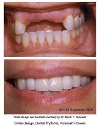 Jan 08, 2018 · according to our research, you can't get free dental implants from dental schools. 29 Best Low Cost Dental Care Ideas Dental Implants Dental Tourism Best Dental Implants