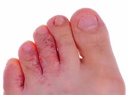 Athlete S Foot Tinea Pedis My Footdr