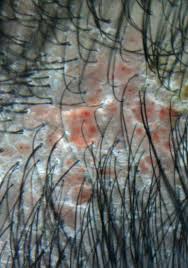 「頭皮のトラブル」の画像検索結果