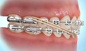 See full list on wikihow.com How To Put Rubber Bands On Braces Premier Orthodontics