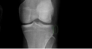 Image result for Segond Fracture