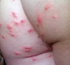 Check spelling or type a new query. Molluscum Pictures Molluscumrx