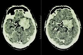 According to the nhs , symptoms of a blood clot in the leg are but if you have symptoms of a blood clot, such as pain and swelling, and also have breathlessness and chest pain does the covid vaccine cause blood clots? The Most Common Symptoms Of A Brain Tumor University Of Utah Health