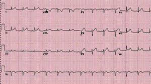 La pericardite acuta è la più frequente patologia del pericardio e si presenta, secondo i per porre diagnosi di pericardite acuta, secondo le attuali linee guida esc, devono obiettivarsi almeno due. Pericardite Acute Si Cronice Cauze De Afectare Pericardica