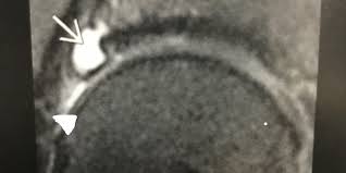 Image result for Hip Labral Tear