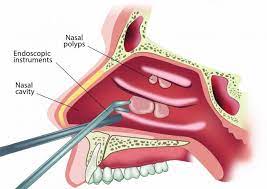 Get detailed information, resources & doctor discussion guides— learn how to get started! Nasal Polyps Treatment Venkat Center For Skin Plastic Surgery