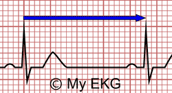 How To Calculate The Heart Rate On An Ekg