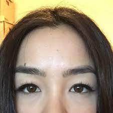 Click a state below to see brow lift before and after pictures showcasing the recent work of leading plastic surgeons in that state. Endoscopic Brow Lift Or Asian Eyelid Surgery Blepharoplasty Photo