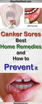 Canker Sores Best Home Remedies And How To Prevent It Fitness Health Fitness Healthy Beauty Diy Workout Canker Sore Natural Cough Remedies Cankers