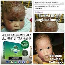 Walau bagaimanapun, sepsis juga boleh berpunca daripada jangkitan lain seperti virus. Cellmaxx Malaysia Testimoni Cellmaxx Eczema Dan Jangkitan Kuman Di K Eczema Dan Baby Face