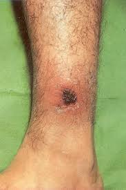 Image result for Rickettsialpox