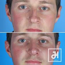 Guys Heads Up This Patient Had Broken His Nose A Few Times In The Past And Not Only Had A Crooked Nos Nose Surgery Rhinoplasty Before And After Rhinoplasty
