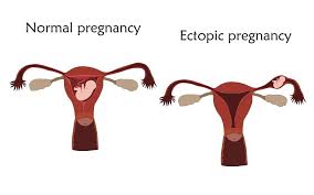 Il sera d'autant plus facile pour le destinataire de distinguer dans l'ensemble des. Grossesse Extra Uterine Symptomes Risques Et Traitements