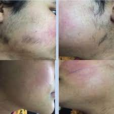 Best laser hair removal clinics near you. Pdf Laser Treatment Of Hirsutism