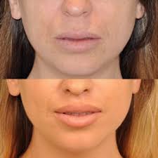 Armonización Orofacial