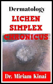 Image result for Lichen Simplex Chronicus