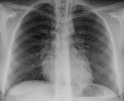 Eine myokarditis kann in jedem alter. Kardiologie Rontgen Thorax Thorax Ct Kardio Ct Kardio Mr