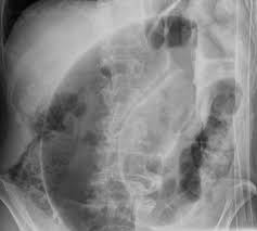 Volvulus Clinical Features Investigations Management Teachmesurgery