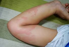 Image result for Papular urticaria