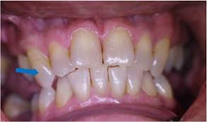 Über eine karies können bakterien den innenraum des zahnes erreichen. Ablauf Der Wurzelspitzenresektion Endodontie Dr Eggert