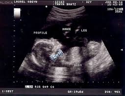 Meet The Bratzes 19 Weeks Gender Reveal Ultrasound Baby Ultrasound Baby Gender Reveal