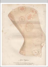 This term was formerly given to various skin diseases, the leprosy of modern authors being lepra arabum. Lepra Vulgaris By Sydney Edwards 1798 16 Download Scientific Diagram