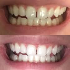 Pin On Fast Teeth Whitening