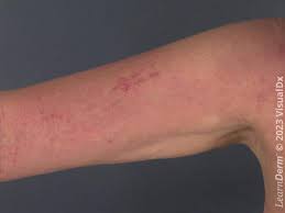 Image result for Linear Dermatitis