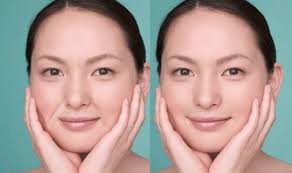 ほうれい線 整形ではない治療法での消し方や消す方法 ほうれい線 整形手術 顔