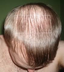 Caboki and couvre concealer + reply to thread. Hair Loss Concealers Toppik Courve Dermhair Clinic 1 310 318 1500