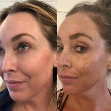 Dr. Massick, dermatologist at #OSUWexMed talks about the "melasma  mustache," and how to treat this skin discoloration.