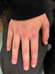 Contraction of the pupil or condition in which the pupil is very small (2 mm or less in diameter). Juvenile Idiopathic Inflammatory Myopathies Pediatric Clinics