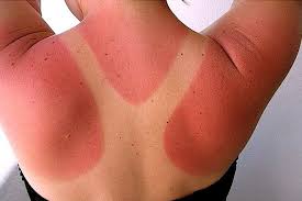 Image result for Sunburn