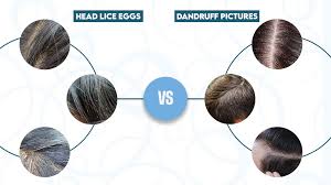 Image result for lice vs dandruff
