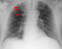 Sie entsteht oft infolge eines verschleppten, grippalen infekts. Kardiologie Rontgen Thorax Thorax Ct Kardio Ct Kardio Mr
