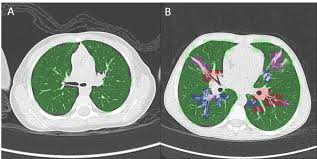 Collins ct, gibson ra, anderson pj, et al. Thirona Obtains Patent For Quantitative Analysis Of Cystic Fibrosis In Children Thirona
