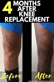 Pin On Mykneereplacementrecovery Com