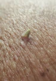 Image result for cornu cutaneum)