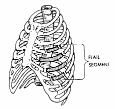 Image result for Flail Chest