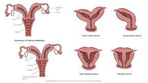 When we were embryos, we had two little mullerian ducts. Mullerian Anomalies Children S Hospital Colorado