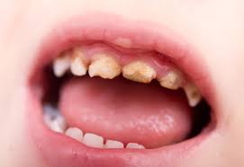 Maybe you would like to learn more about one of these? Denby Fawcett Hawaii Children S Decaying Teeth Are A Disgrace Honolulu Civil Beat
