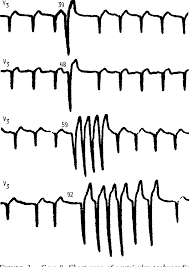 Image result for Extrasystole