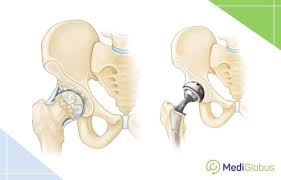 Check spelling or type a new query. Price Of Hip Arthroplasty Abroad Mediglobus